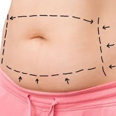 abdominoplastie en tunisie