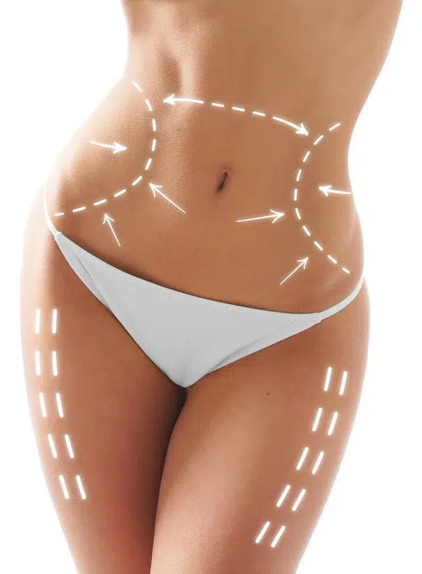 liposuccion en tunisie