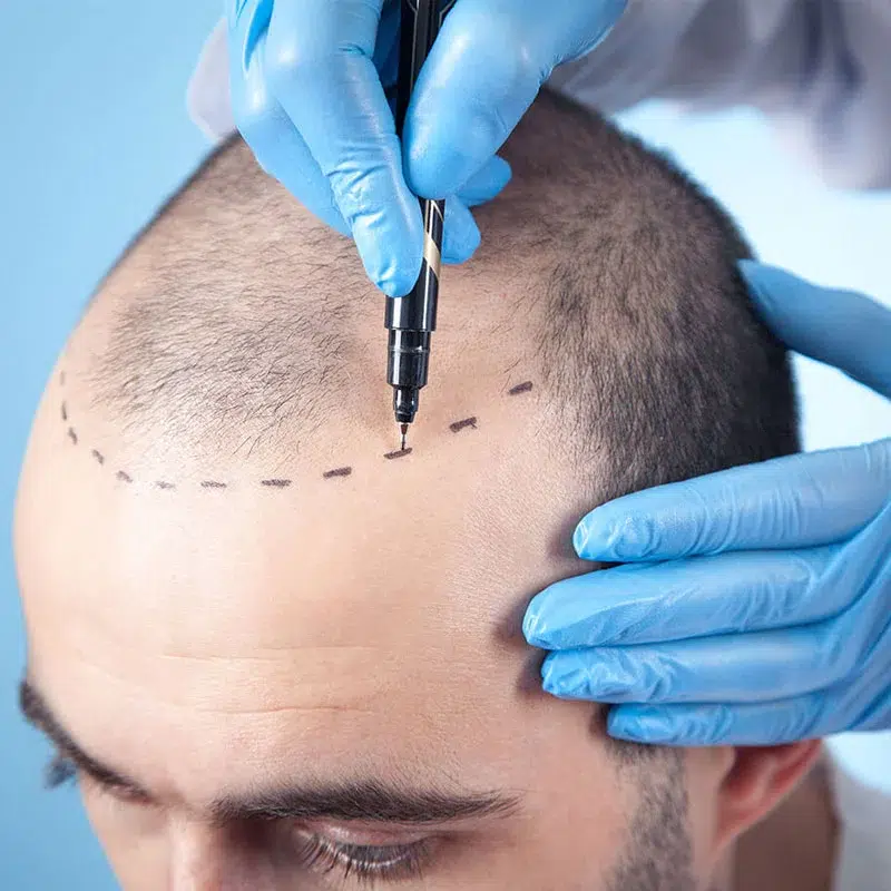 greffe de cheveux en tunisie