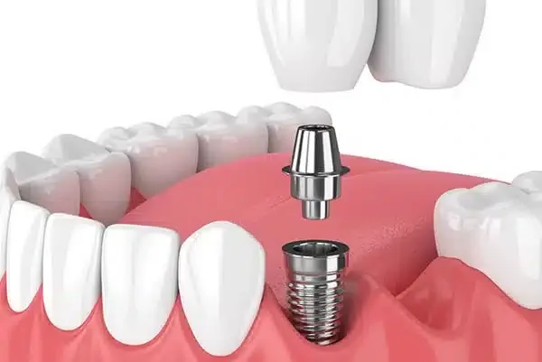 Implant dentaire tunisie prix