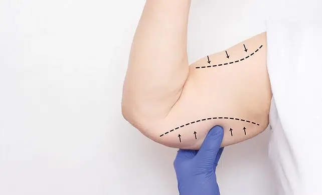 Lifting bras Tunisie