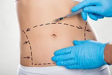 abdominoplastie-tunisie