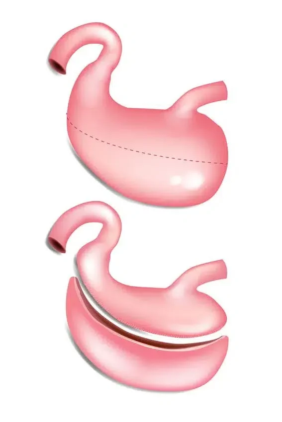 bypass gastrique en Tunisie