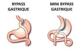 bypass gastrique tunisie