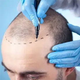 greffe de cheveux en Tunisie